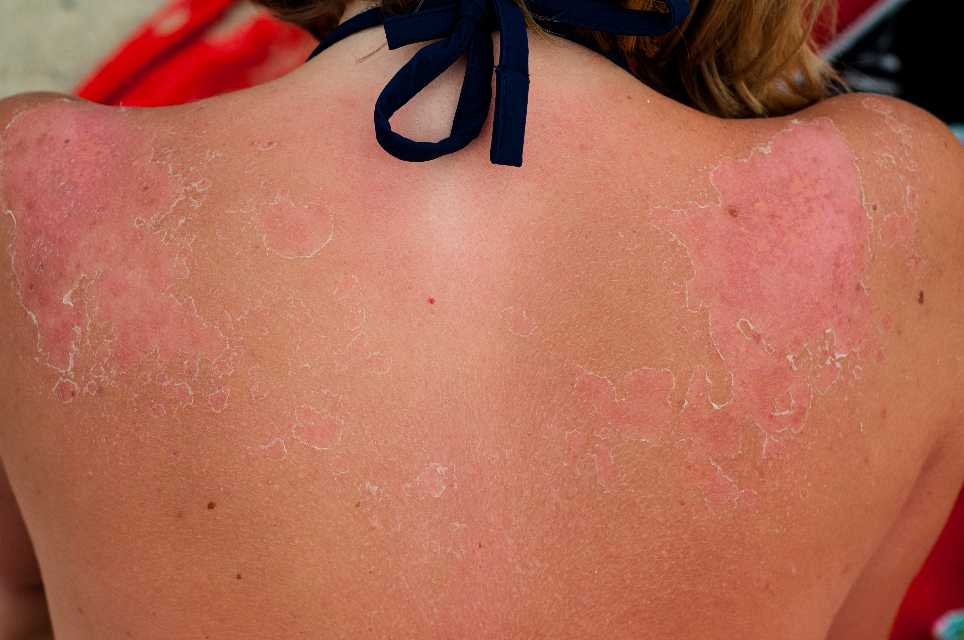 woman with sun burnt skin that is peeling. She is wearing a black tie bikini